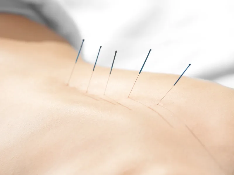 Acupuncture at ProKinetic in Fort Scott