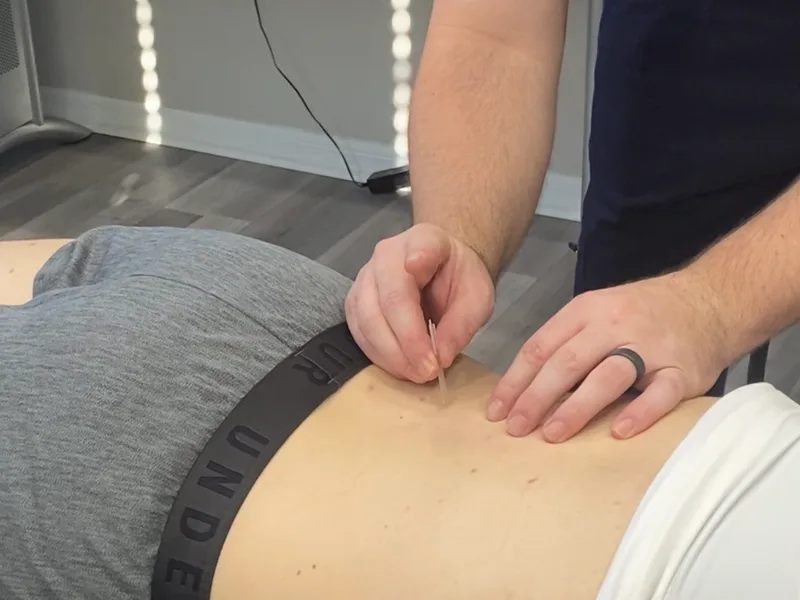 How Dry Needling works at ProKinetic