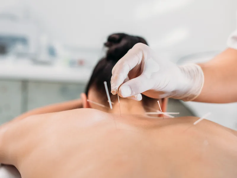 Dry Needling at ProKinetic in Fort Scott